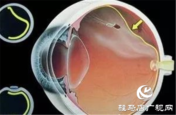 一只眼睛視網(wǎng)膜脫落，另一只也會脫落嗎