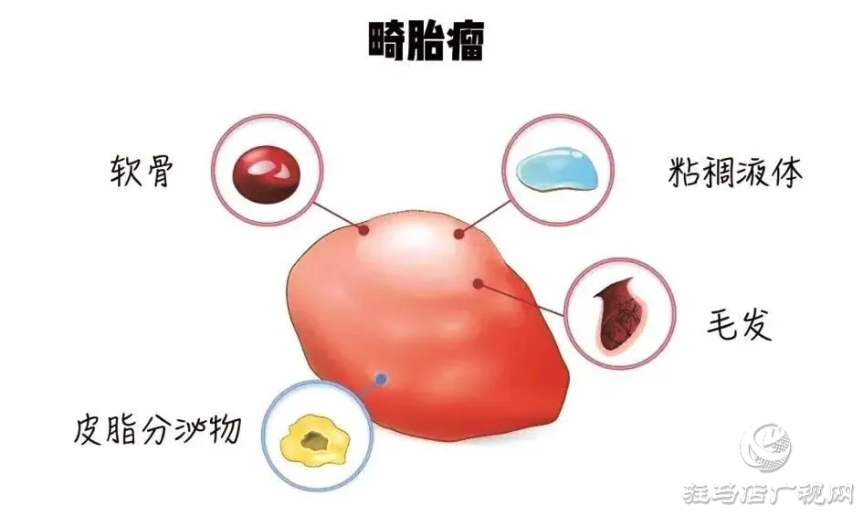 百聞不如一見！14歲少女“身懷怪胎”?