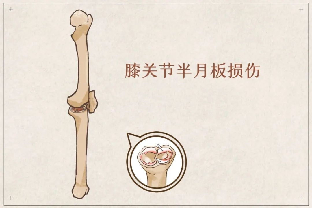 盲目鍛煉？你的半月板傷不起